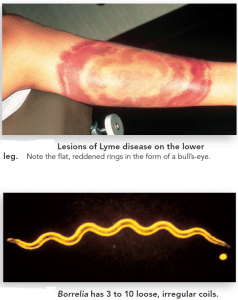Lyme Disease| Overview