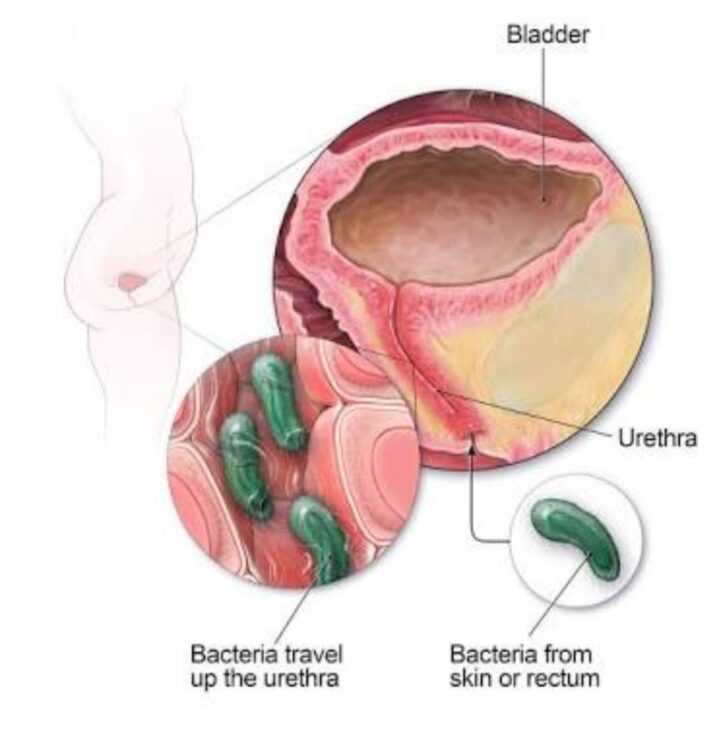 Urinary tract infection (UTI): Symptoms, Cause, Types and Treatment