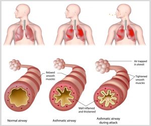 ASTHMA: THE OVERVIEW.