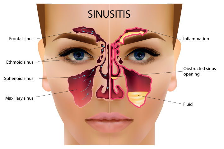 Sinus Infection Biology Ease