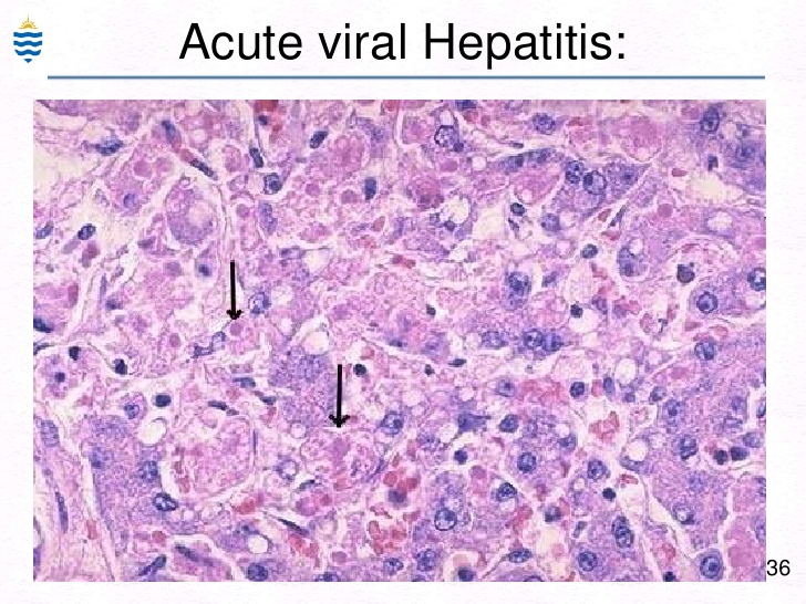 acute viral hepatitis
