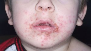 impetigo