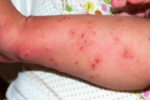 scabies
