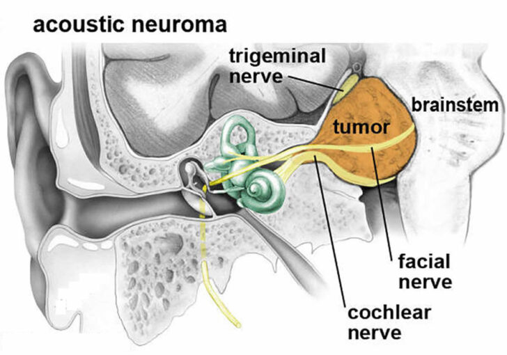 acoustic neuroma