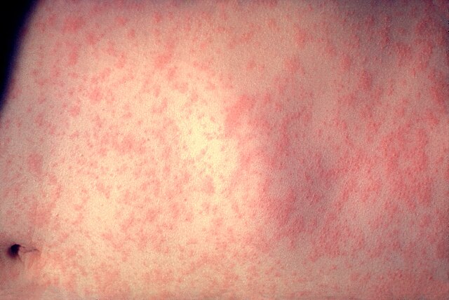 Measles