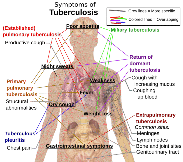Tuberculosis symptoms