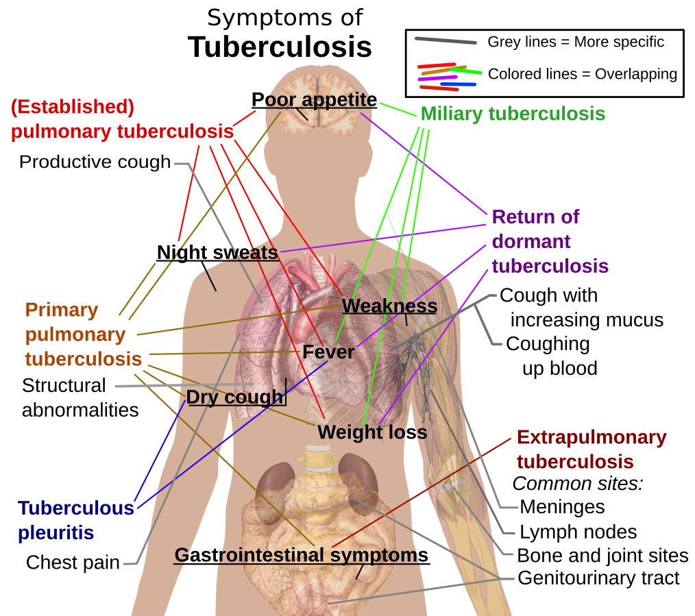 Tuberculosis symptoms