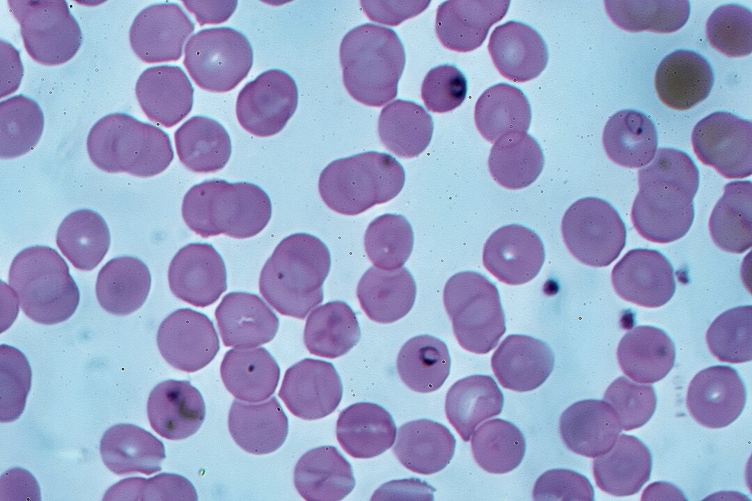 Ring forms of Plasmodium falciparum in red blood cells (Giemsa stain)